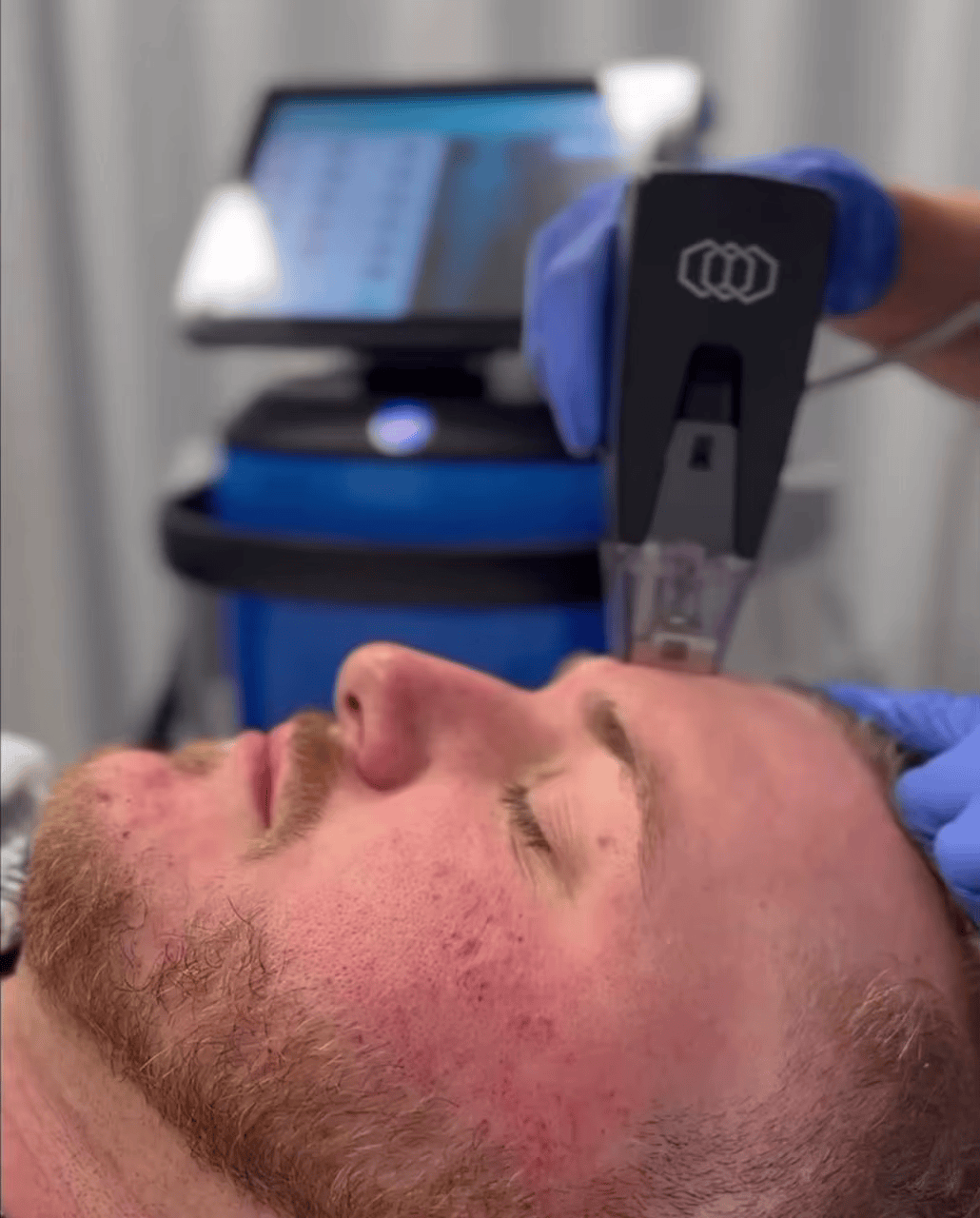 Vault Of Wellness Skin Lifting Radiofrequency Microneedling Machine